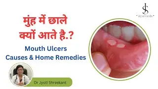 Mouth ulcers causes | Mouth ulcers home remedies in Hindi