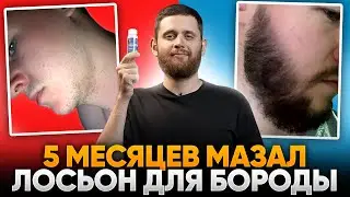 Результаты ксиноксина для роста бороды в 24 года / Отменил и продолжил курс
