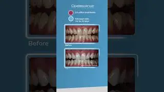 Opalescence™ Boost™ and Opalescence™ PF | Case Study