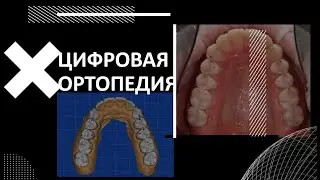 ЦИФРОВАЯ ОРТОПЕДИЯ ФИШКИ