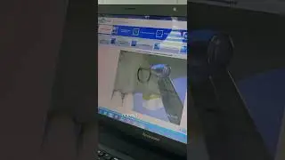 Как устанавливают имплантат, если давно нет верхнего зуба?