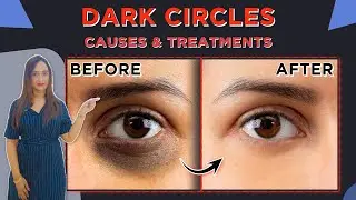 आंखों के काले घेरे - कारण और उपाय | Symptoms, Causes & Treatment of Dark Circles |Dr Priyanka Ghatge