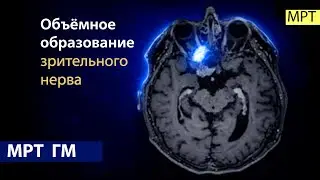 Объемное образование зрительного нерва на МРТ