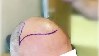 Demarcación Zona Implante Capilar. Clínica Merced 👨‍⚕️👩‍⚕️