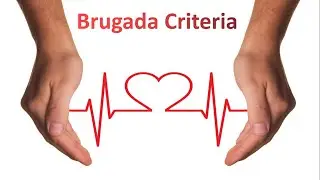 Brugada Criteria for VT vs SVT I ECG Made Super Easy