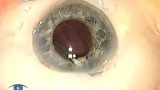 Conjunctival Sweeping for Chemosis Phaco 3.1 Complications