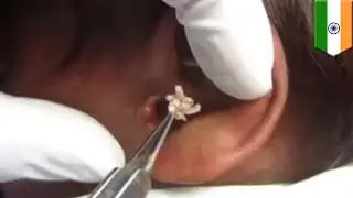 Dokter mengangkat belatung dari telinga pria - Tomonews