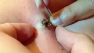 あごの毛抜き②（５倍速）　Pull out the Beard ２ 【tweezers】（5speed）