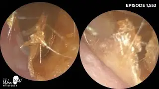 1,553 - Complete Dead Skin Peel of the Ear