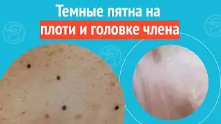 👉 Темные пятна на плоти и головке члена. Клинический случай №1224