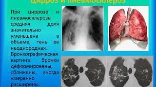 Диссеминированные и очаговые заболевания легких