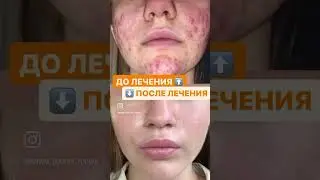 ДО.и ПОСЛЕ лечения у доктора Юдиной М.М.
