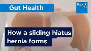 How a sliding hiatus hernia forms | Bupa Health