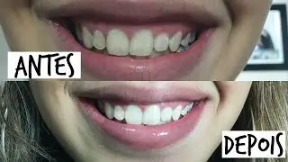 COMO CLAREAR OS DENTES EM 1 MINUTO! ♡Amanda Borges