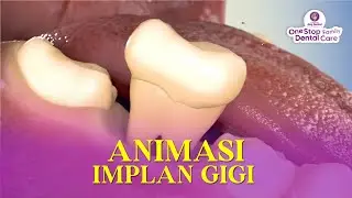 GIGI HILANG ? JANGAN KAWATIR ! IMPLAN SOLUSINYA !