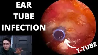 Infected Ear Tube Cleaning (T-TUBE)