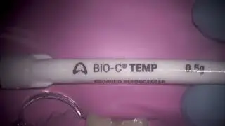 Placement of Bio C temporary intra canal medicament from Angelus