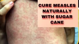 Natural Home Remedy For Measles Using Sugar Cane
