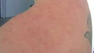 PLE shoulder before treatment