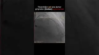 RETROGRAT CTO | Kronik tam tıkalı kalp damarının tersten açılması