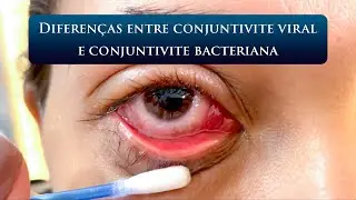 DIFERENÇAS ENTRE CONJUNTIVITE VIRAL E CONJUNTIVITE BACTERIANA