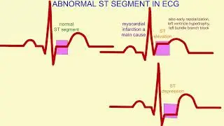 Abnormal ECGs
