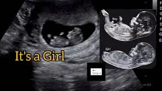 it's a baby girl 🤱by 'Nub Theory' !! Ultrasound