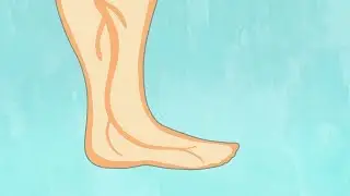 Pregnancy swelling (edema)