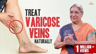 Natural Cure for Varicose Veins | Home Remedies to Treat Varicose Veins | Dr. Hansaji Yogendra