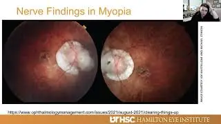Lecture: Glaucoma in the Myopic Eye