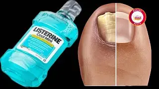 ESTA FÁCIL RECETA eliminará los hongos en las uñas, ¡para siempre