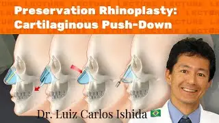 Preservation Rhinoplasty: Cartilaginous Push-Down