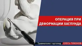 Деформация Хаглунда хирургическое лечение, снимки до и после операции