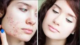 Как убрать рубцы | Мой личный опыт