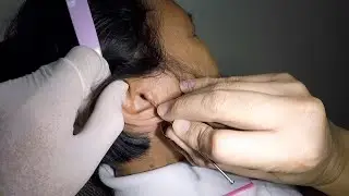 Trying to Remove Hard Earwax from Woman's Ear