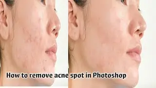 How to remove acne spot in Photoshop Bangla