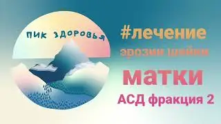 Лечение эрозии шейки матки АСД фракция 2 .Шейка матки #эрозияшейкиматки#лечение#АСД 2#шейкаматки