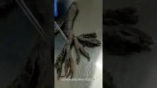 Árbol bronquial