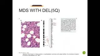 Cytogenetics and Molecular Testing in MDS