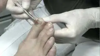 Nagelkorrekturspange