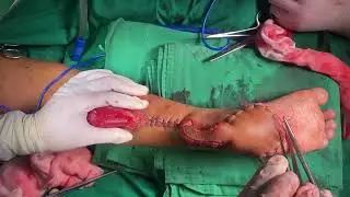 Reverse Sural Flap | @dr.bobrambe