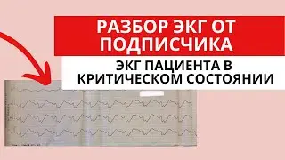ECG Analysis from a Subscriber. Patient in Critical Condition. (Acute Coronary Syndrome)