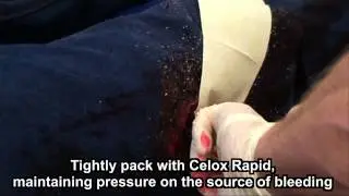 Celox Rapid Haemostatic Z-Fold Gauze