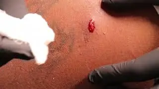 This Cyst looked small but…….🫣🫣😳😳