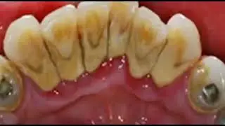 هذه اقوي وصفه مجربه للتخلص من جير الاسنان ورائحة الفم الكريهه مجربه واكيده،//مع نوسه