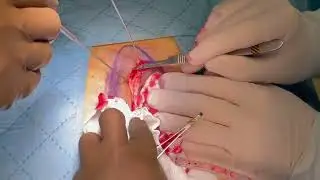 Bascom’s Cleft Lift Procedure for Pilonidal Sinus Disease: A Video Vignette