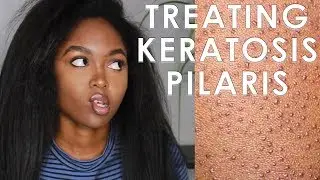TREATING KERATOSIS PILARIS - 3 EASY STEPS