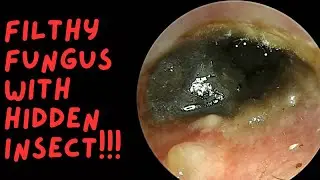 FILTHY Fungus With Hidden Insect 😳😳😳