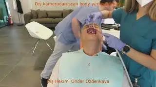 Heron IOS Üstçene implant üstü scan body (Maxilla) Taraması 1