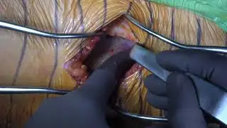 TriFit TS™ and Trinity™, DAA surgical procedure with Dr. Kreuzer Part 2